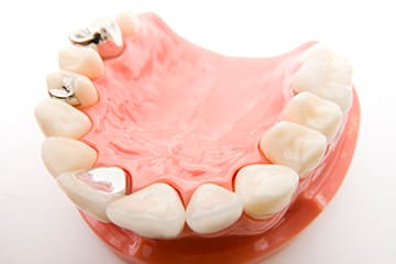 銀歯のリスク