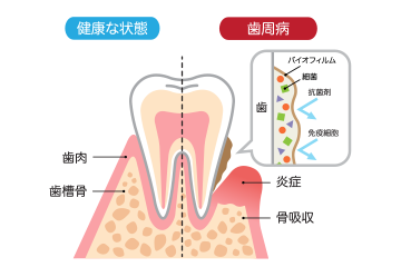 サイレントディジーズ「歯周病」は、早期治療が重要です